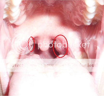 wanna see my swollen tonsils warning gross pics ultimate guitar